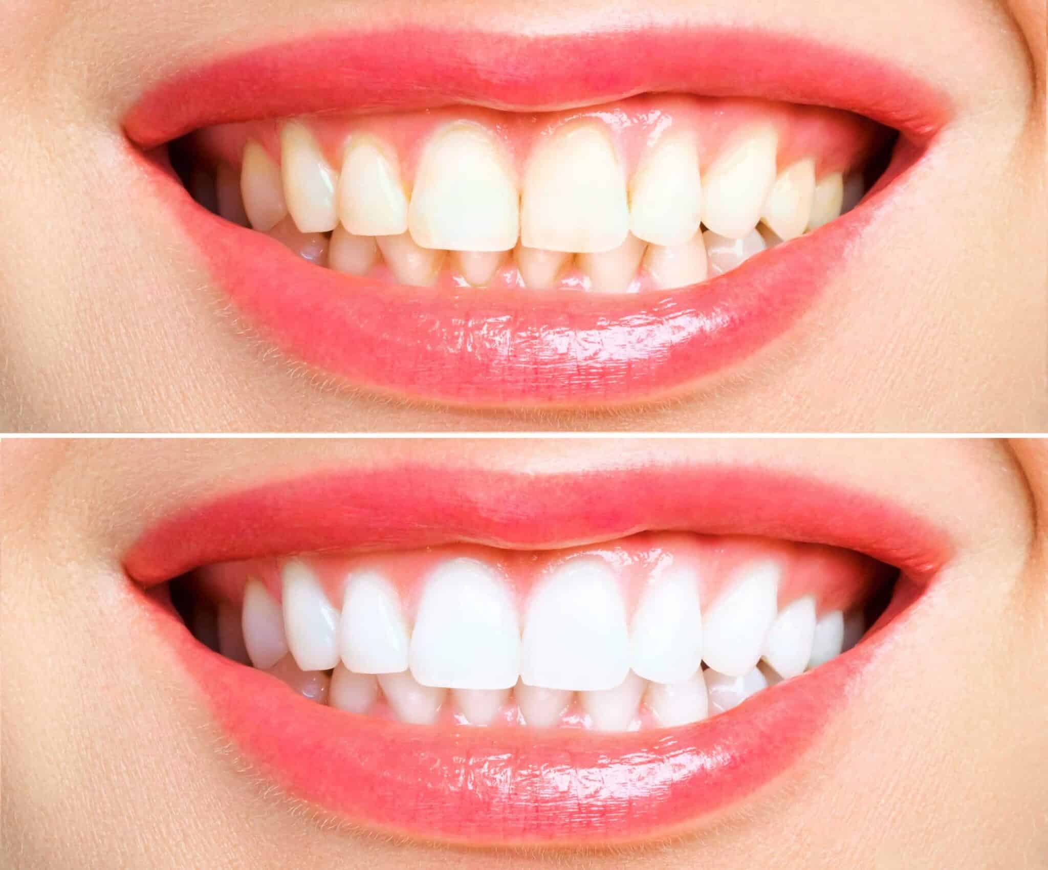Teeth whitening Hilversum