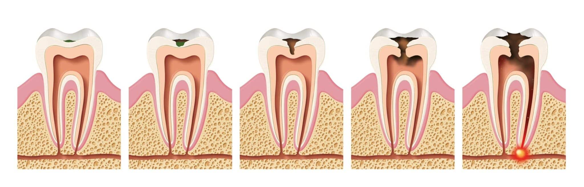 root canal treatment Hilversum